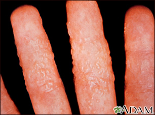 Dermatitis - reaction to tinea