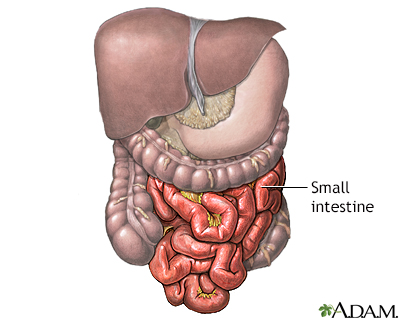 Meckel's diverticulectomy - normal anatomy