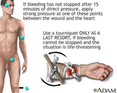 Stopping bleeding with a tourniquet