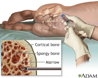 Bone marrow aspiration