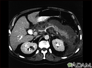 Pancreatitis, acute - CT scan