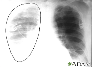 Aortic rupture - chest X-ray