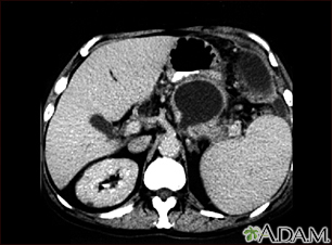 Pancreatic pseudocyst - CT scan