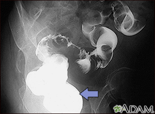 Sigmoid colon cancer - X-ray