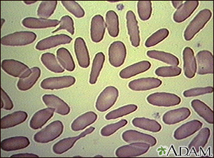 Red blood cells - elliptocytosis