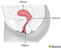Cervical dysplasia - series