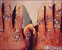 Warts, multiple - on hands