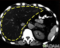 Fatty liver - CT scan