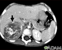Neuroblastoma in the liver - CT scan