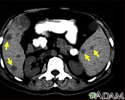 Spleen metastasis - CT scan