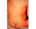 Rubella on an infant's back