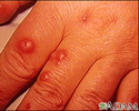 Cryptococcus - cutaneous on the hand