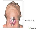 Thyroidectomy - Series