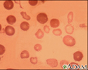 Thalassemia major