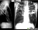 Tuberculosis, advanced - chest X-rays