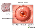 Cervical erosion