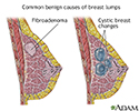Causes of breast lumps