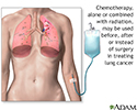 Lung cancer - chemotherapy treatment