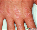 Dermatomyositis - Gottron's papules on the hand