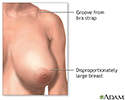 Breast reduction (mammoplasty) - series - Indications