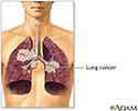 Secondhand smoke and lung cancer