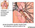 Causes of acute bronchitis