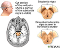 Substantia nigra and Parkinson disease