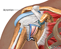 Impingement syndrome