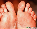 Hand, foot, and mouth disease on the soles