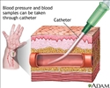 Peripheral arterial line