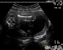 Ultrasound, normal fetus - femur measurement