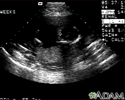 Ultrasound, normal fetus - ventricles of brain