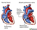 Absent pulmonary valve