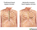 Heart bypass surgery incision