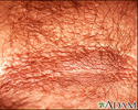 Acanthosis nigricans - close-up