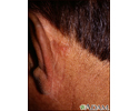 Skin cancer, basal cell carcinoma - behind ear