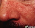 Dermatitis seborrheic - close-up