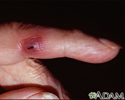 Janeway lesion on the finger