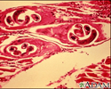Trichinella spiralis in human muscle