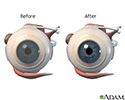 Before and after corneal surgery