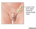 Swollen lymph nodes in the groin