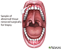 Gum biopsy