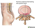 Herniated nucleus pulposus