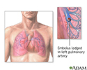 Pulmonary embolus