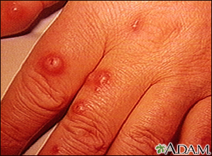 Cryptococcus - cutaneous on the hand