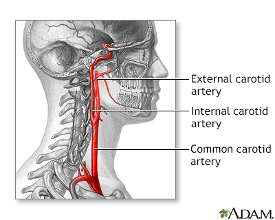 Carotid artery surgery - series