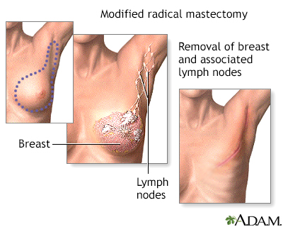 Mastectomy - Procedure part 2