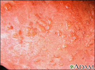 Dermatitis, herpetiformis - close-up of lesion
