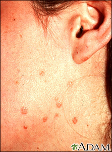 Warts - flat on the cheek and neck