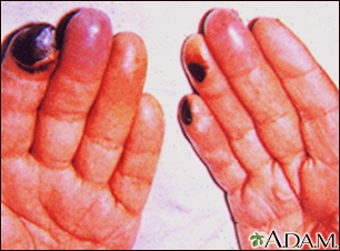 Cryoglobulinemia of the fingers